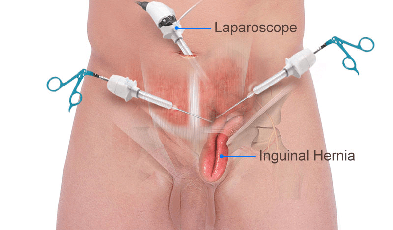 laparoscopie 1